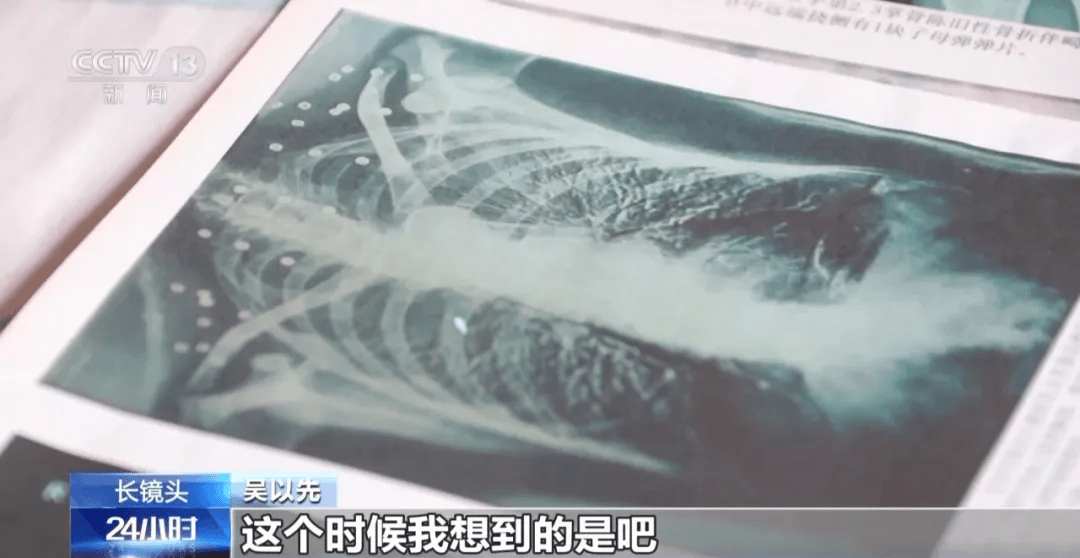 “老先生，您把项链取下来再做CT”